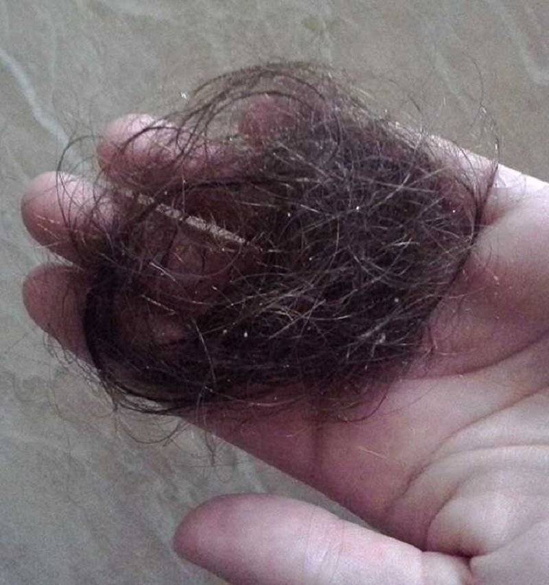 Выпадают волосы у женщины сильно на голове. Сотное выпадение волос.