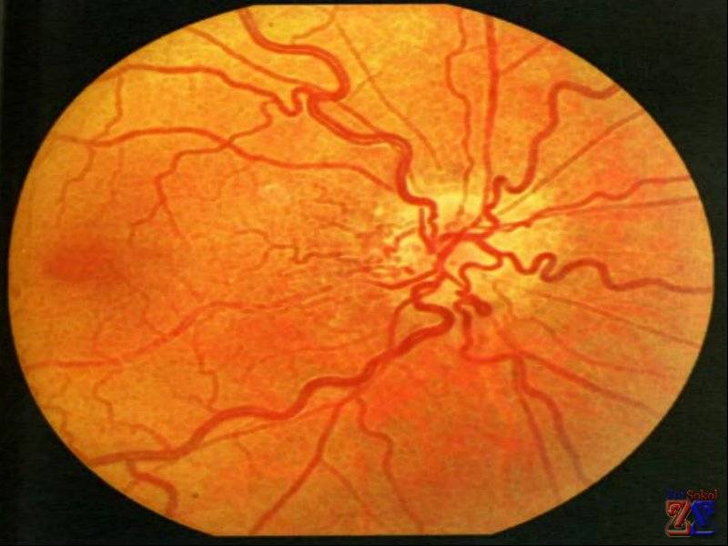 Ангиопатия сетчатки глаза: лечение каплями и другими способами