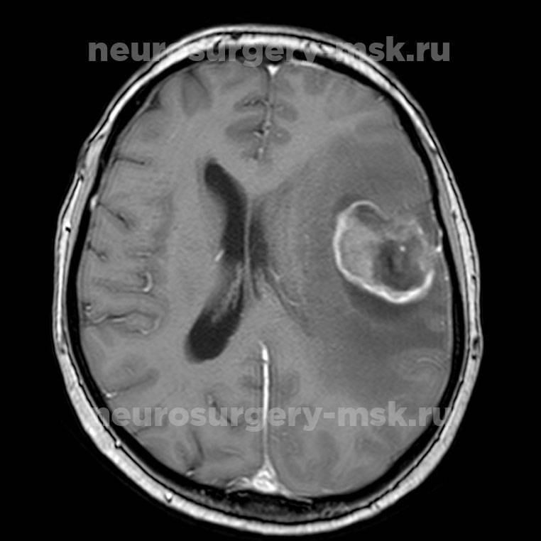 Опухоли ствола мозга - симптомы болезни, профилактика и лечение опухолей ствола мозга, причины заболевания и его диагностика на eurolab