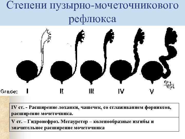 Пузырно мочеточниковый рефлюкс