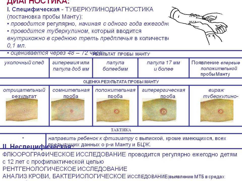 4 вопроса к пробе манту, или 5 задач, которые решает туберкулинодиагностика