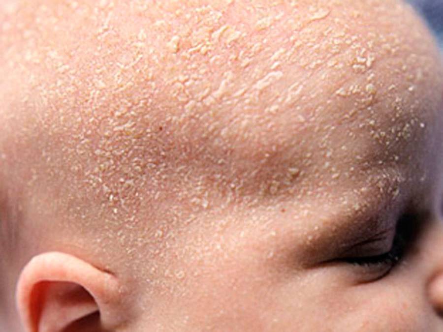Себорейный дерматит на голове. как лечить у взрослых и детей