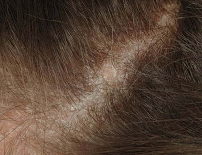Причины и лечение себорейного дерматита волосистой части головы у детей