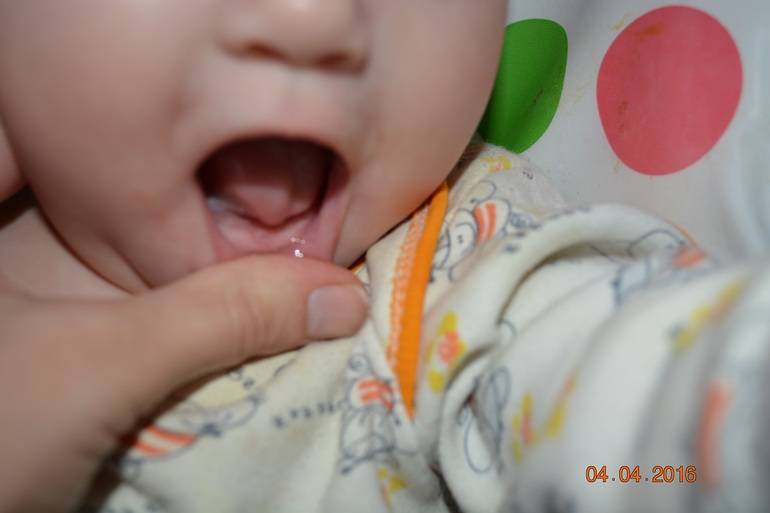 Насморк у ребенка при прорезывании зубов — зубы