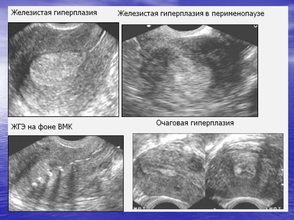 Гиперплазия полости матки