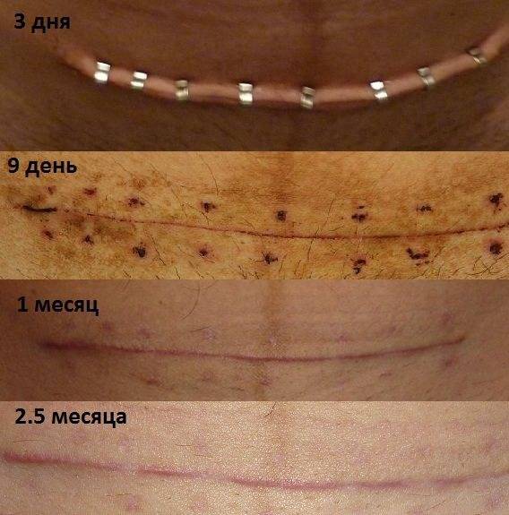 Уплотнение под швом после операции | moninomama.ru