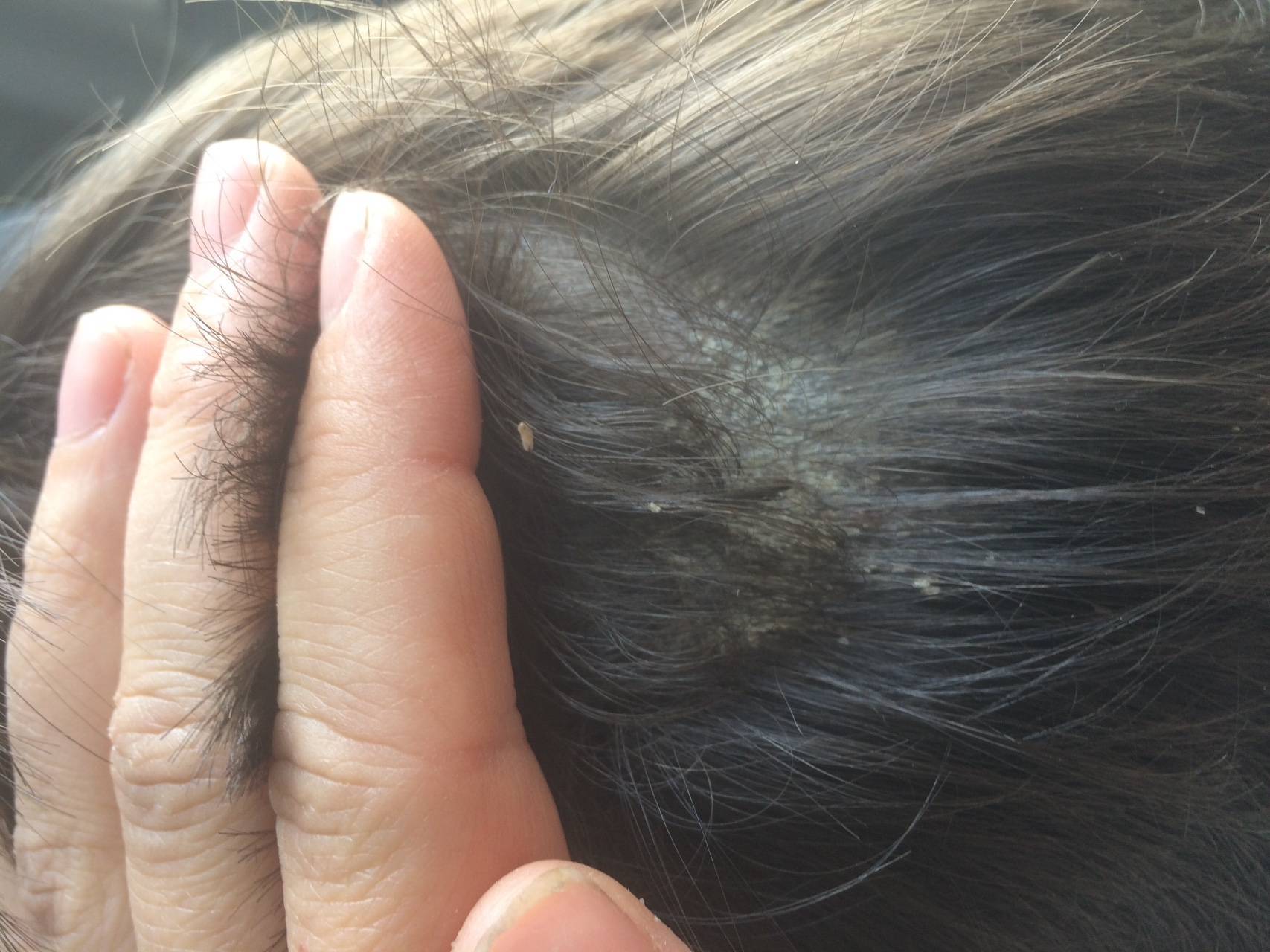 Аллергический дерматит на голове: лечение кожи головы после покраски волос - клиника «доктор волос»