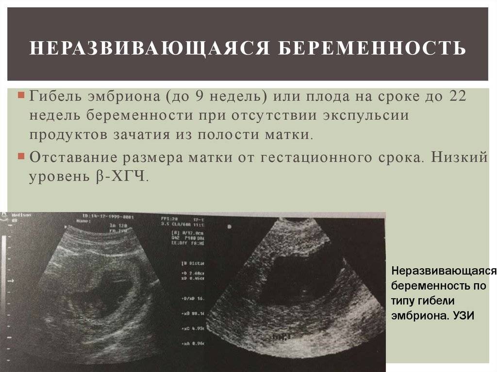 Первые признаки беременности после введения процедуры эко женщине — ответ врачей