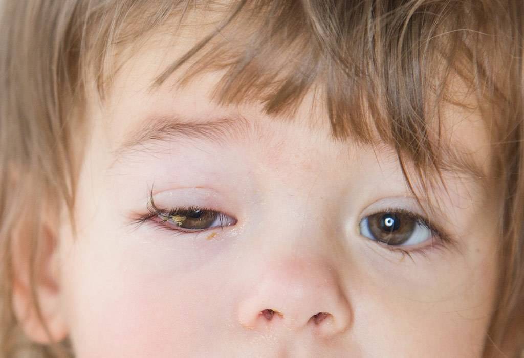 Конъюнктивит у ребенка: лечение глаз, симптомы с фото и профилактика заболевания