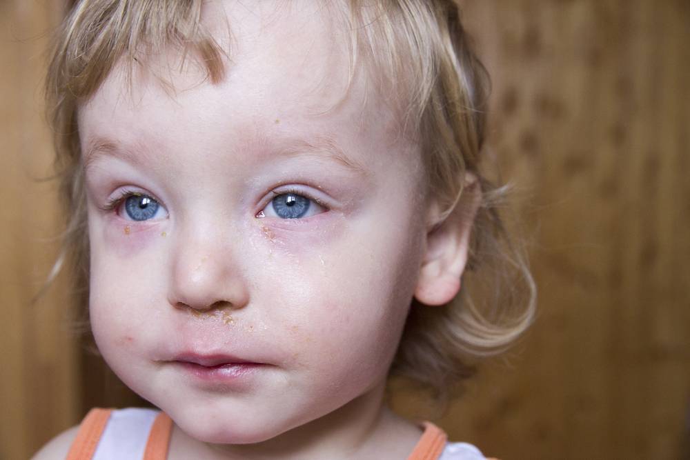 Конъюнктивит у детей - виды, причины, диагностика и лечение | детская офтальмология см-