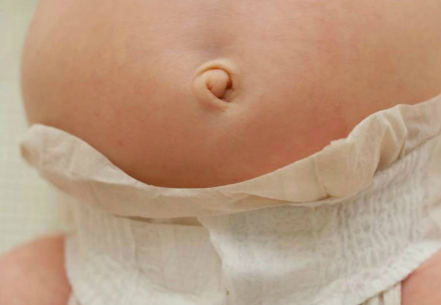 Кровит пупок у новорожденного с прищепкой или после ее отпадения