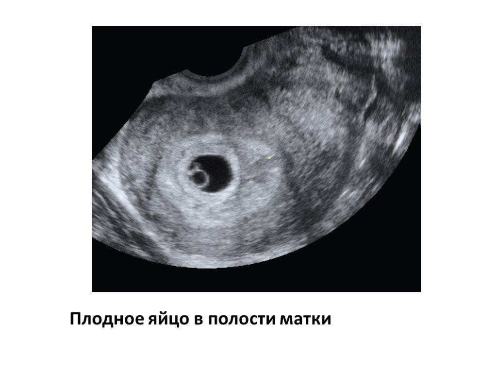 Когда в ходе узи видно плодное яйцо, почему эмбрион в матке не визуализируется на сроке 6–7 недель беременности?