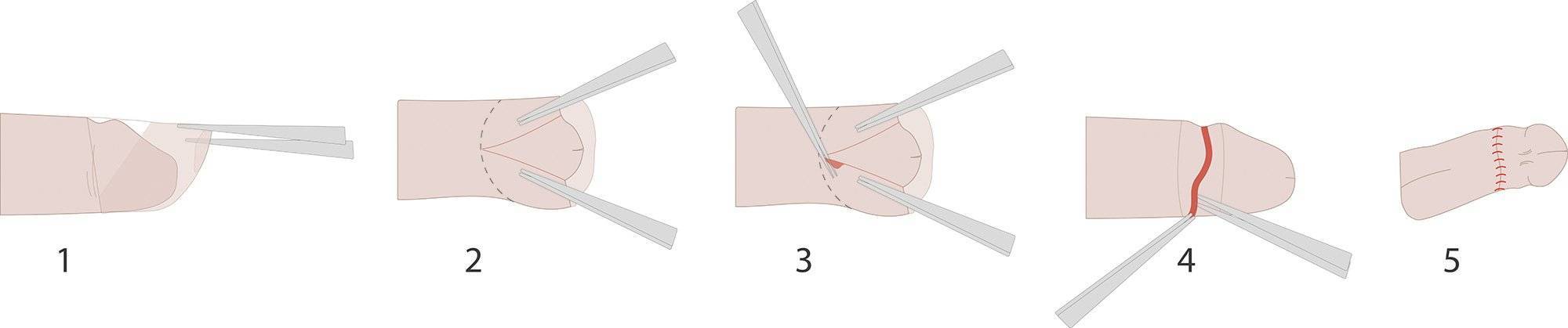 Обрезание крайней плоти у мужчин (циркумцизия) в санкт-петербурге: подробно о процедуре и способах обрезания - неомед (812)249-0-249
