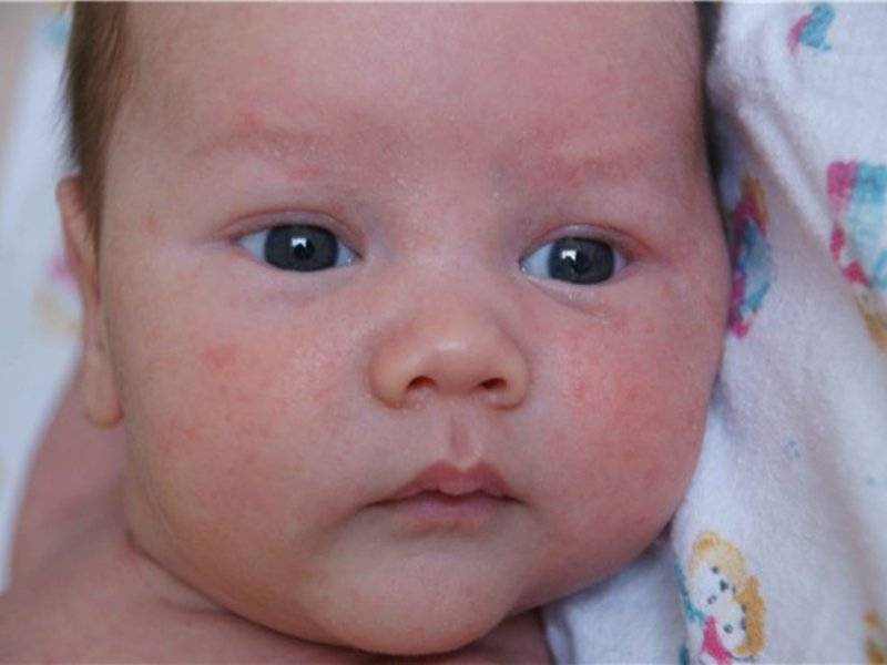 Что делать, если появились высыпания на коже младенца? | детская городская поликлиника № 32