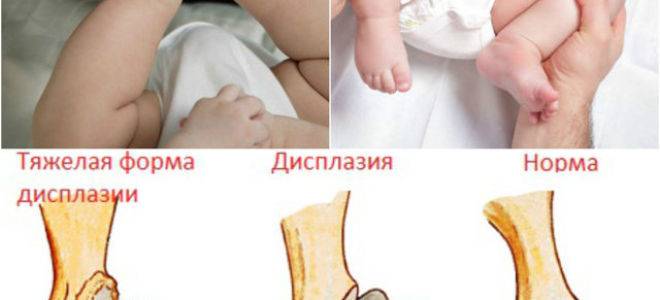 Почему хрустят колени у ребенка — суставы