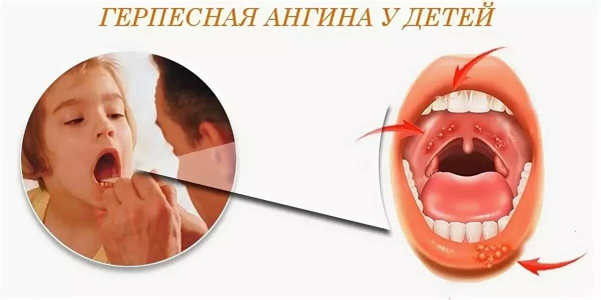 Бактериальная ангина у детей, лечение — блог фурасол®