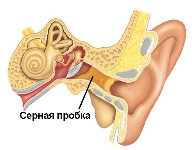 Из чего состоит ушная сера. Серная пробка на барабанной перепонке. Анатомия уха серная пробка. Серная пробка приросла к барабанной перепонке. Барабанная перепонка отит разрыв.