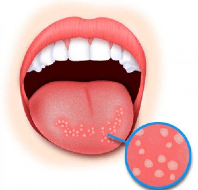 Герпес во рту у ребенка: фото, лечение белых пузырьков на языке, профилактика инфекции