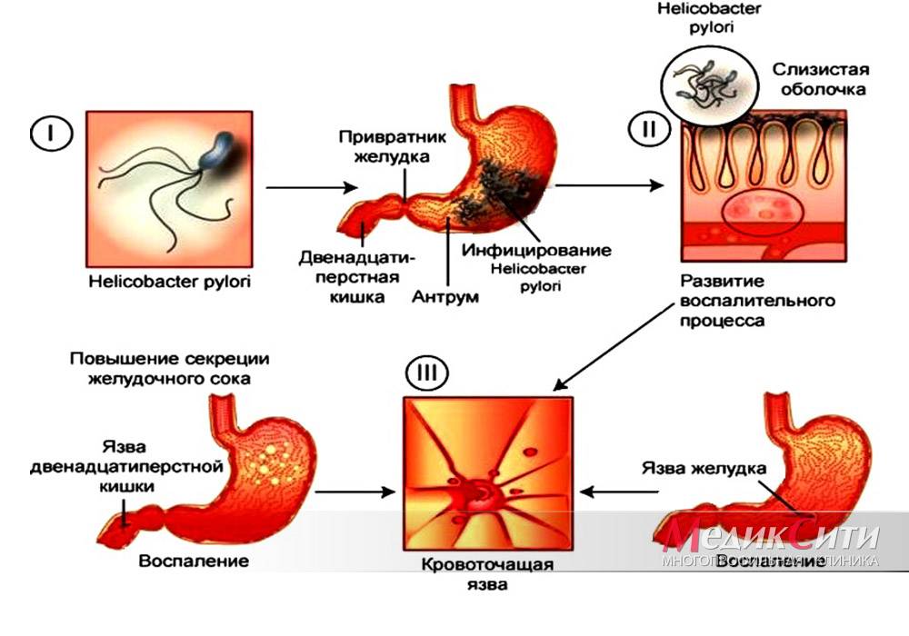 Лечение язвенного гастрита желудка по схеме