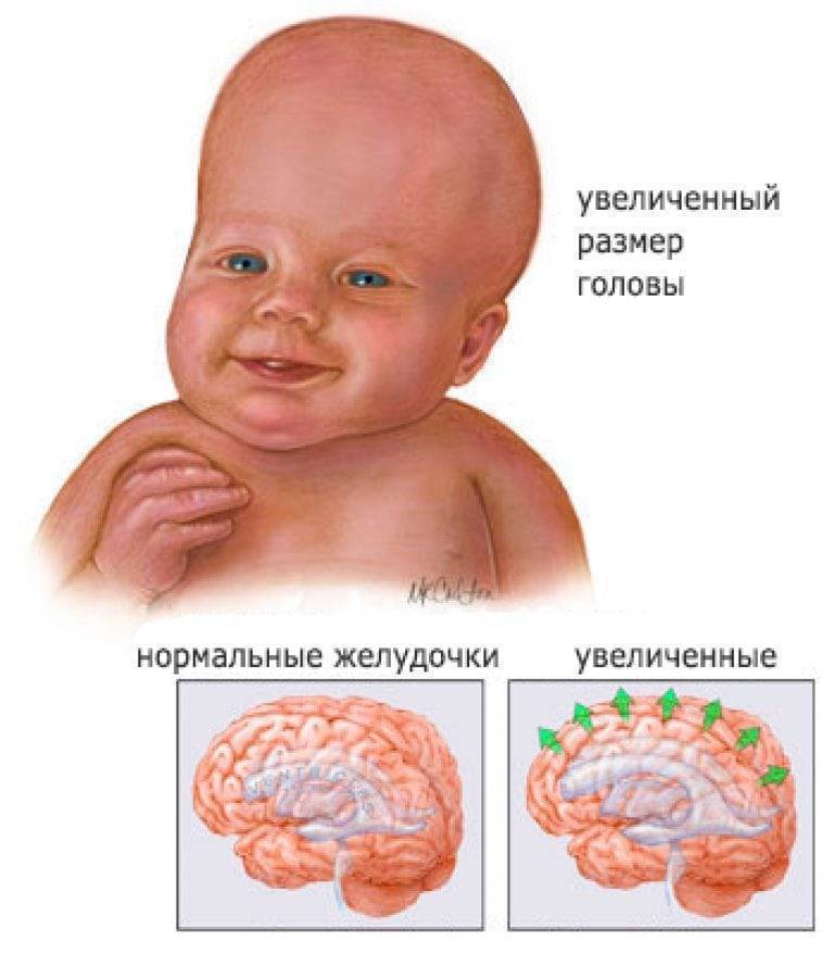 Статья детского невролога о родничке у ребенка - mdclinic