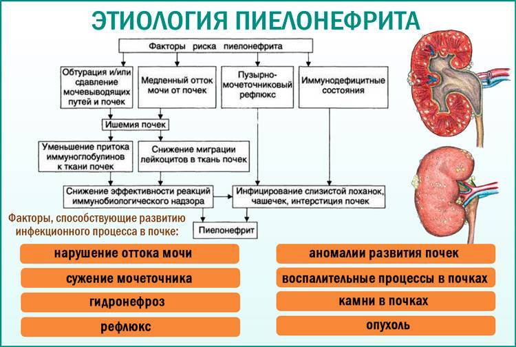 Заболевания мочевыводящих путей