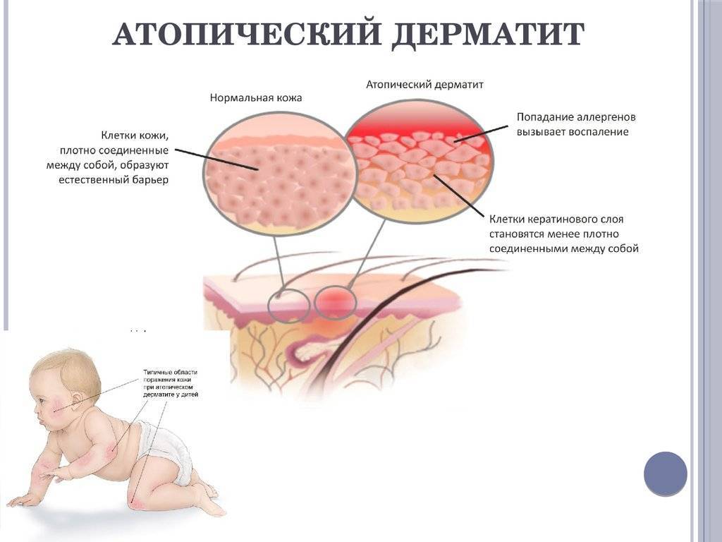 Атопический дерматит у детей: фото, лечение, симптомы в начальной стадии