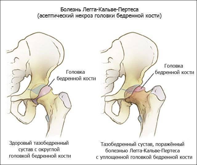Артрит коленного сустава - симптомы, степени и лечение