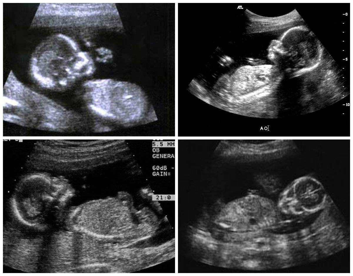 10 недель беременности описание и фото — евромедклиник 24