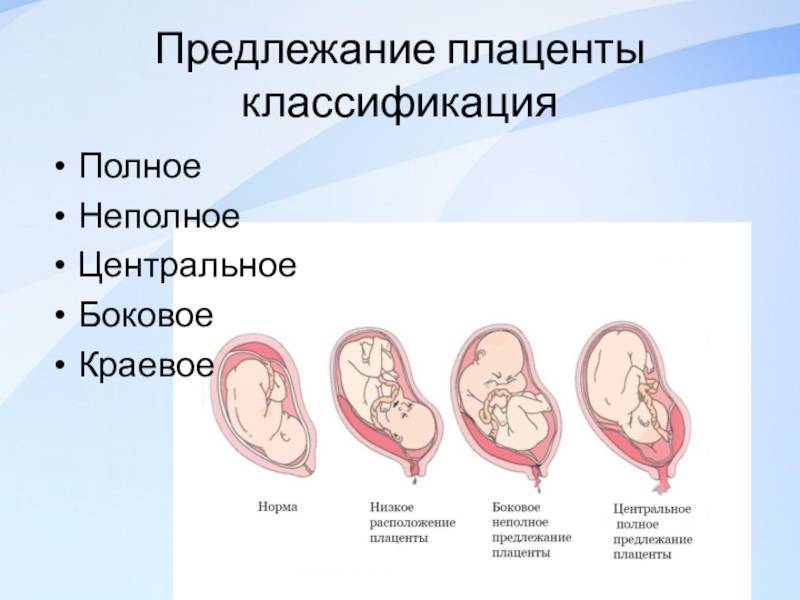 Низкое расположение плаценты