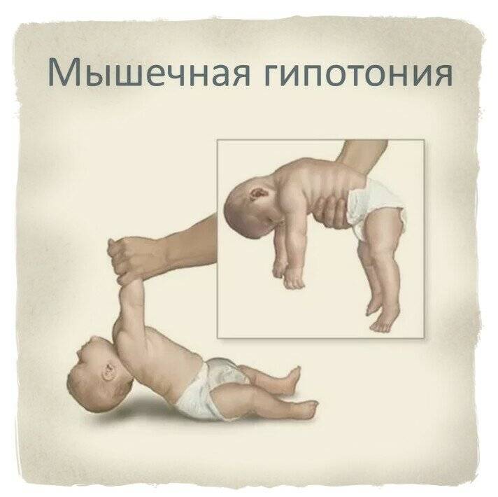 Гипертонус у детей до года