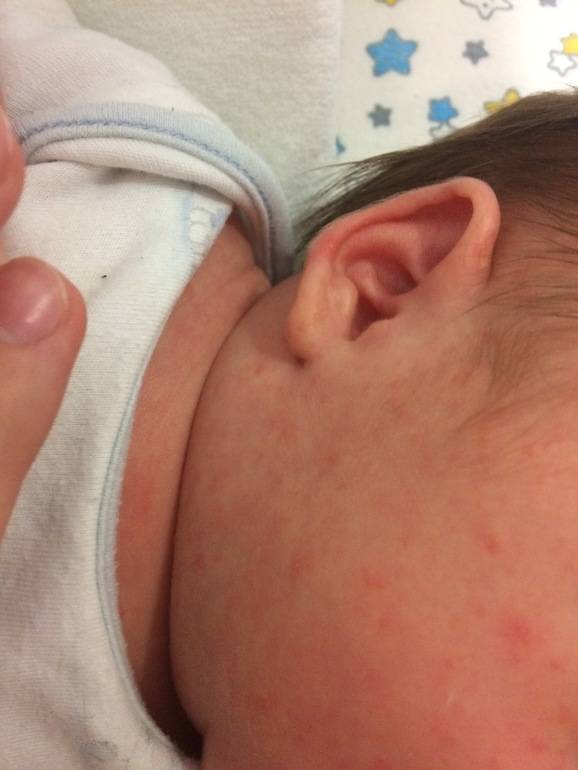 Красные прыщики на лице у новорожденного: симптомы, причины и лечение | mustela