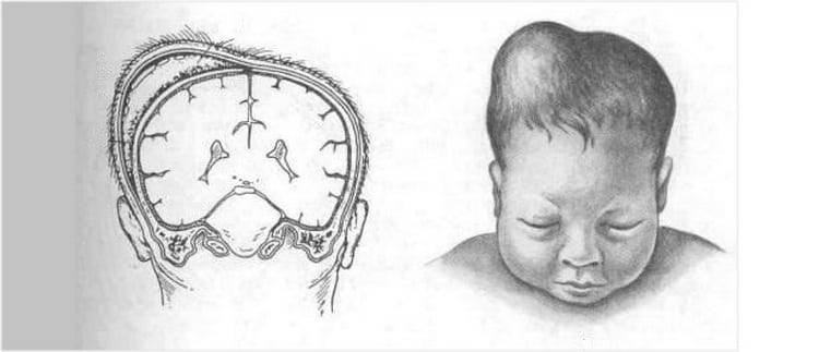 Гематома у новорожденного на голове после родов: лечение ребенка и последствия