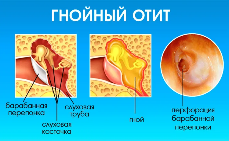 Чем лечить отит у ребенка в домашних условиях