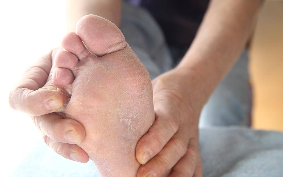 Грибок на ногах - как выглядит, почему возникает и как его лечить? :: polismed.com