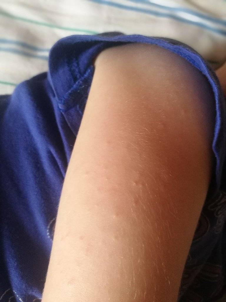 Красные пятна на коже при аллергии – как лечить красные пятна на коже у ребенка на руках и ногах