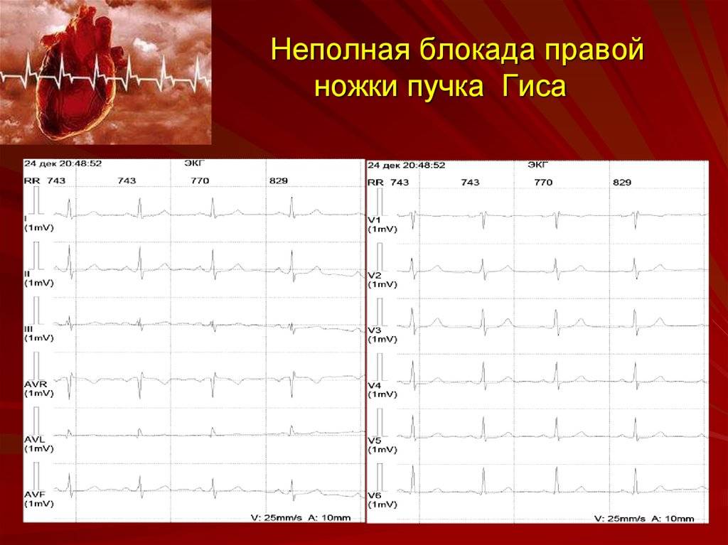 Неполная блокада правой ножки пучка гиса фото