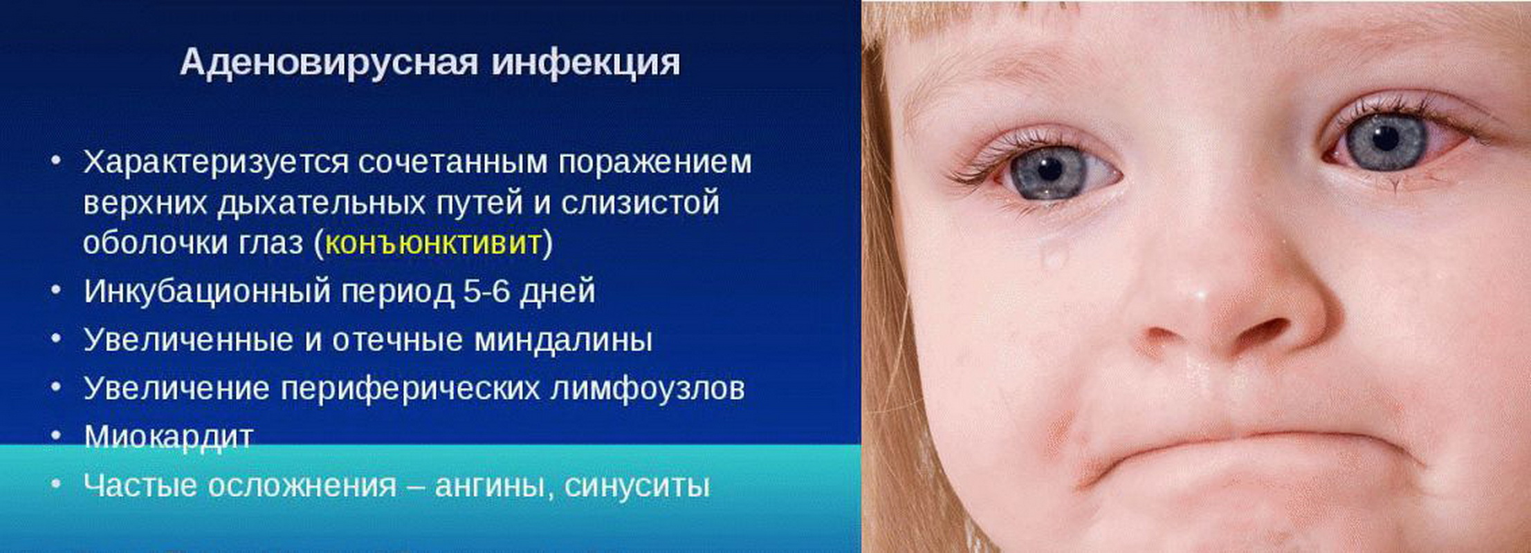 Лечение аденовирусной инфекции у детей -
