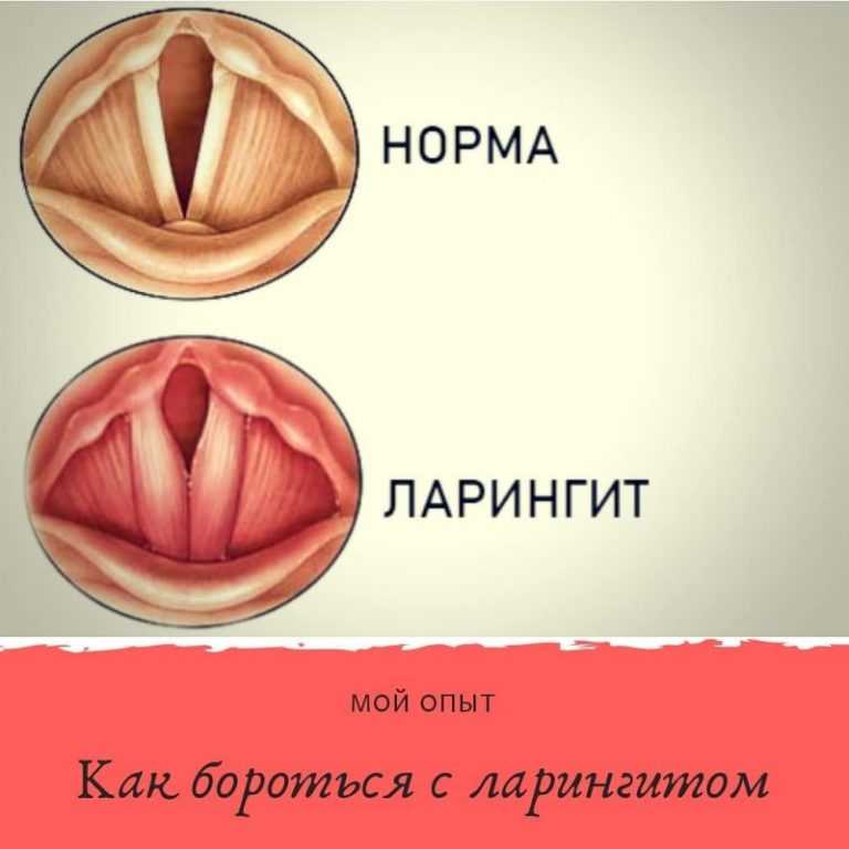 Как лечить ларингит у детей: советы педиатра