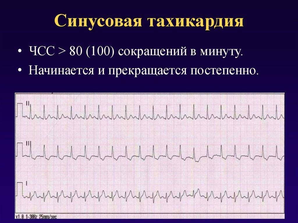 Синусовая тахикардия карта смп