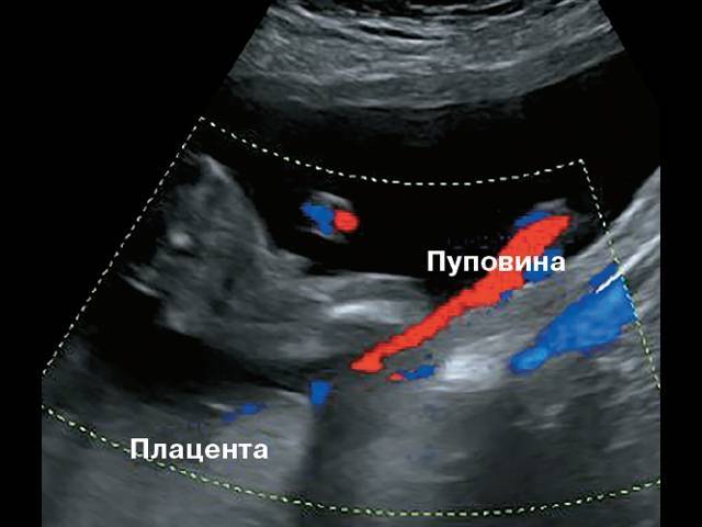 В пуповине расположены сосуды. Оболочечное прикрепление пуповины УЗИ. Как выглядит пуповина на УЗИ.