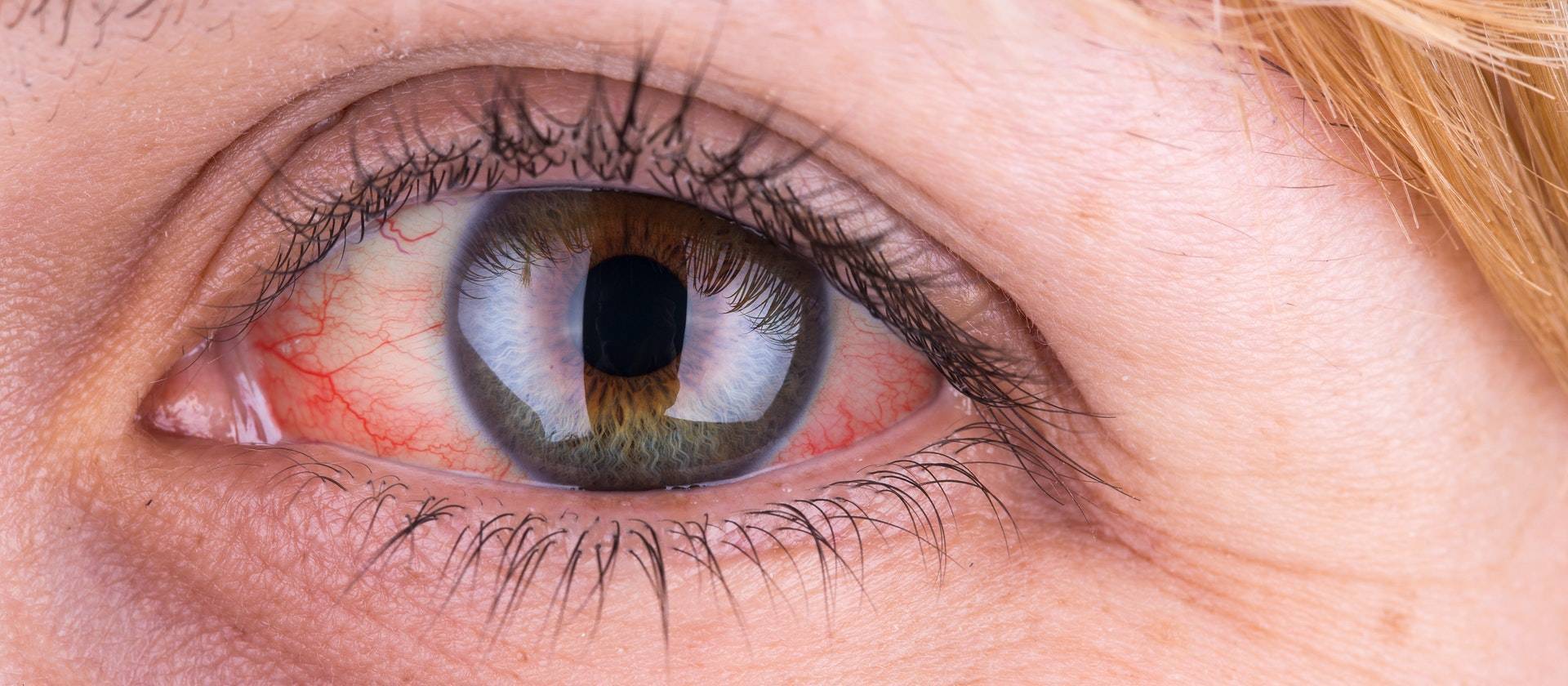 Почему лопаются сосуды: причины покраснения глаз | центр зрения оптика плюс
