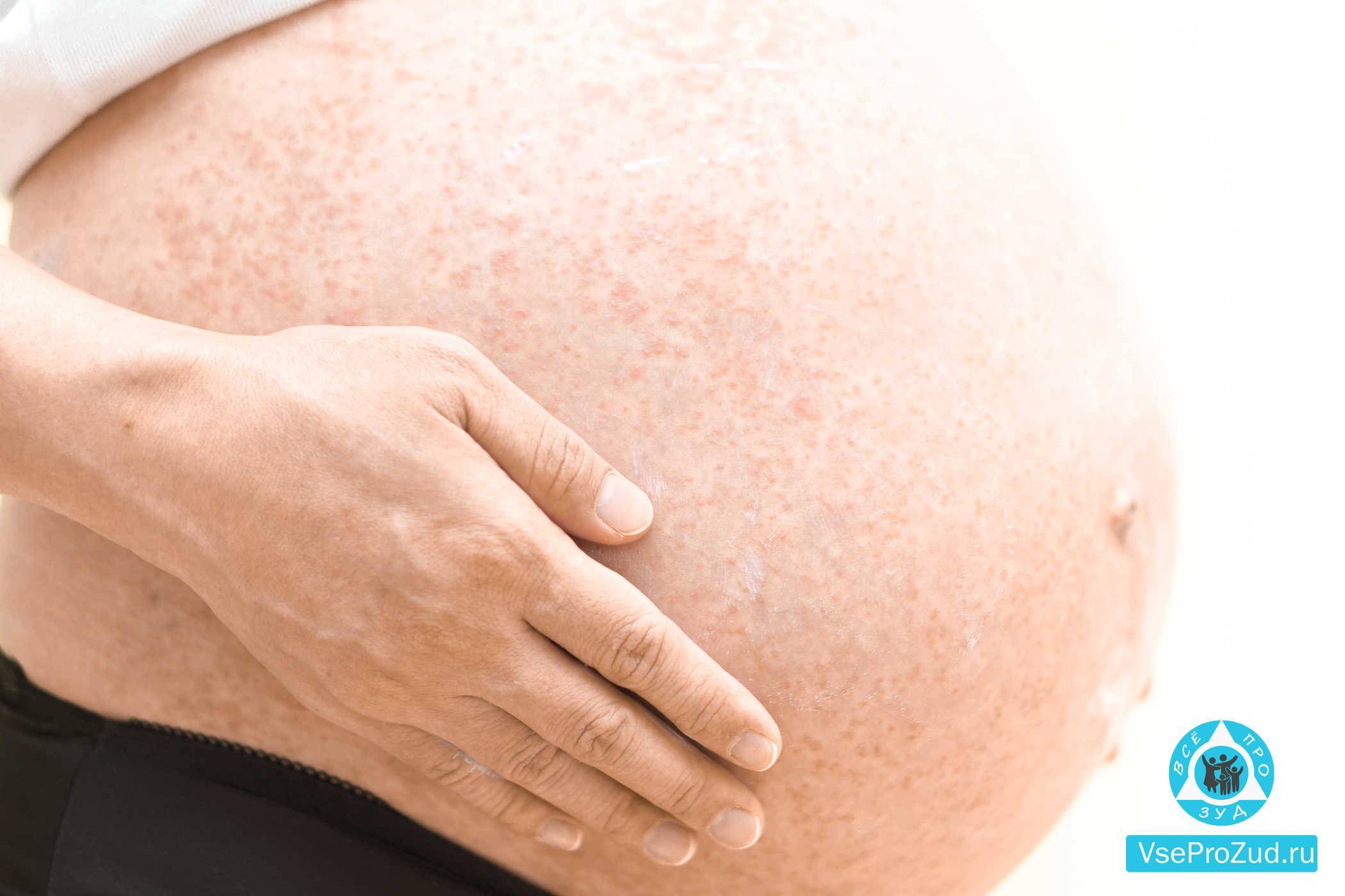 Шелушится кожа при беременности: причины и способы лечения