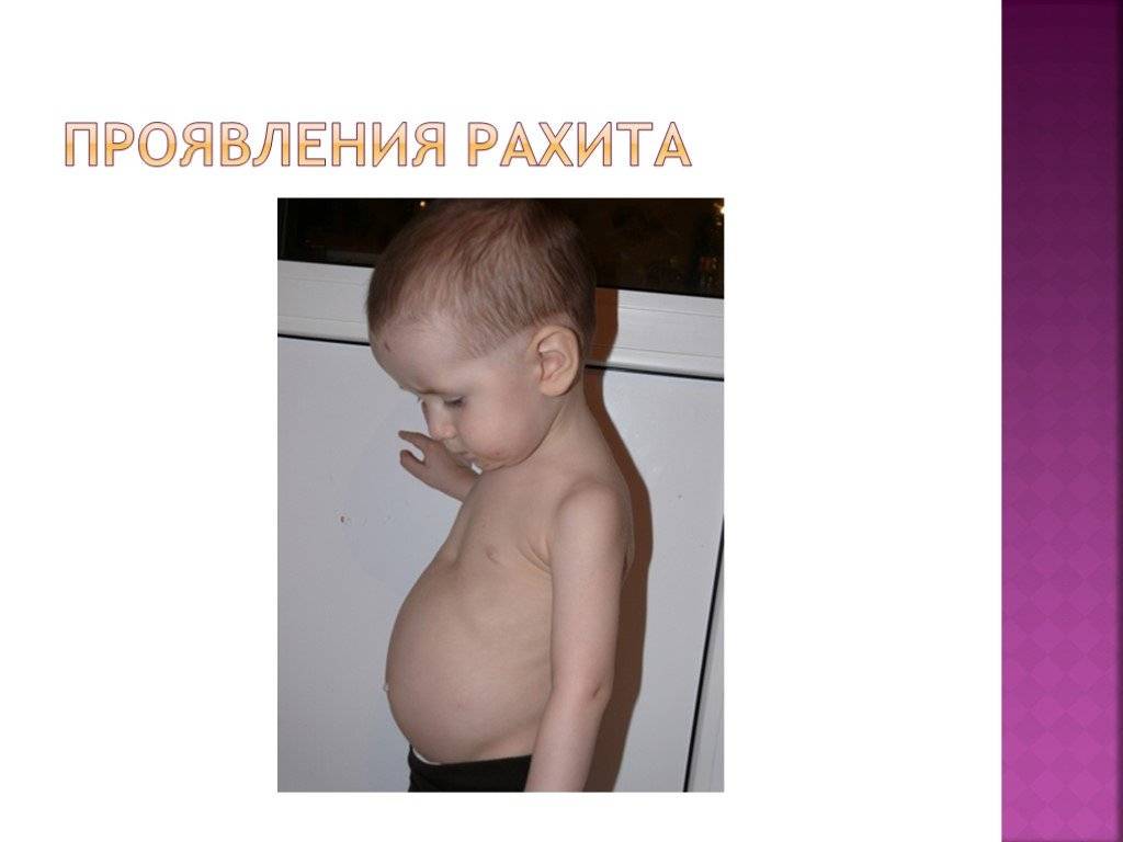 Признаки рахита у грудничков, лечение, причины, стадии рахита у детей