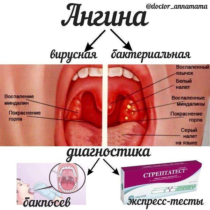Чем лучше и как правильно лечить тонзиллит у ребенка?