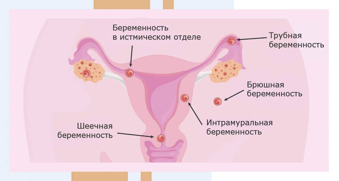 Можно ли забеременеть с полипом в матке?