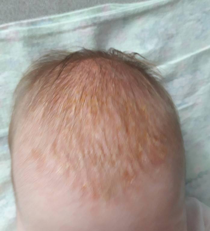 Корочки на голове у грудничка или новорожденного: как и чем убрать + мнение доктора комаровского