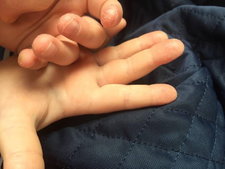 У ребенка облазит кожа на пальцах рук: советы родителям