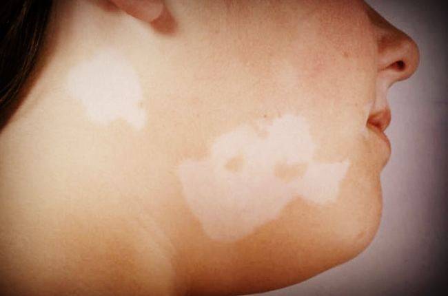 Почему на коже у ребенка может появиться белое пятно, что означает этот симптом?