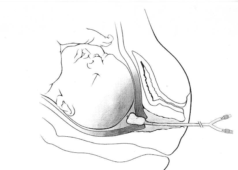 Катетер фолея для раскрытия шейки матки перед родами: показания и порядок проведения процедуры