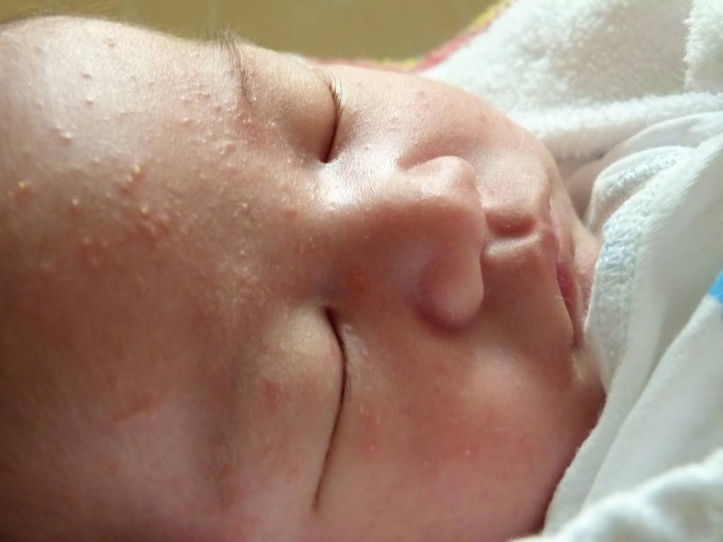 Опрелости у новорожденных: как выглядят и чем лечить | профилактика опрелостей у грудничка (на попе, шее, в паху, на ногах)